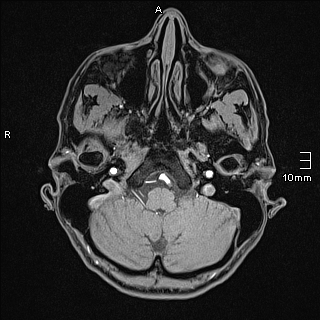 Basilar artery perforator aneurysm (Radiopaedia 82455-99523 F 14).jpg