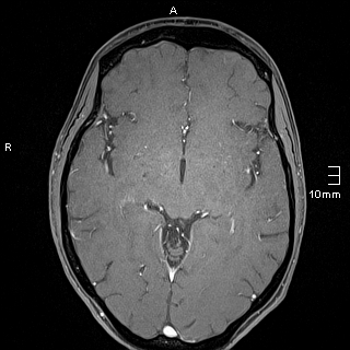 Basilar artery perforator aneurysm (Radiopaedia 82455-99523 G 71).jpg
