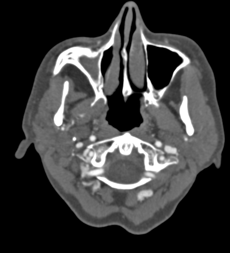 Basilar tip aneurysm with coiling (Radiopaedia 53912-60086 A 8).jpg