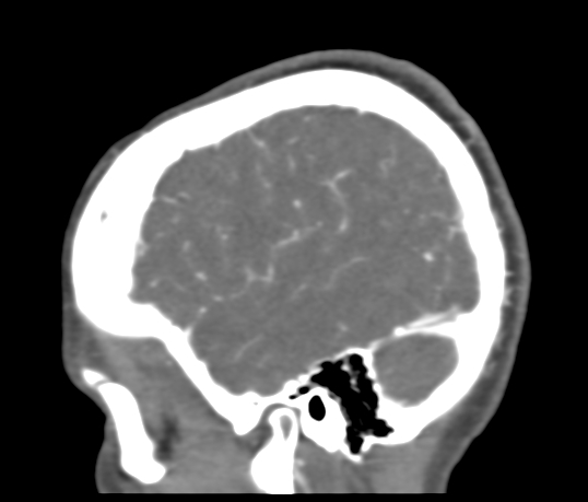 File:Basilar tip aneurysm with coiling (Radiopaedia 53912-60086 C 114).jpg