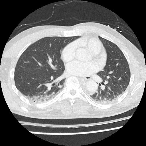 Benign post-traumatic pseudopneumoperitoneum (Radiopaedia 71199-81495 Axial lung window 42).jpg