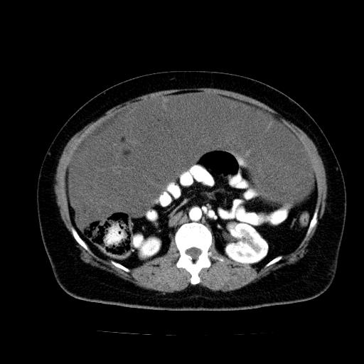 Benign spindle cell tumor - abdominopelvic (Radiopaedia 61300-69212 A 27).jpg