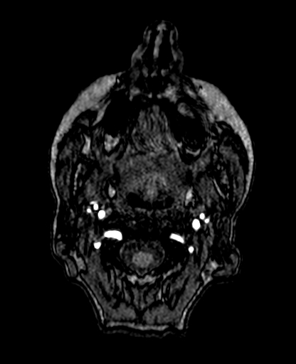 File:Berry aneurysm of the terminal internal carotid artery (Radiopaedia 88286-104918 Axial TOF 6).jpg