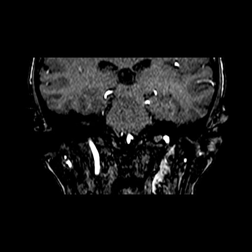 Berry aneurysm of the terminal internal carotid artery (Radiopaedia 88286-104918 Coronal TOF 61).jpg