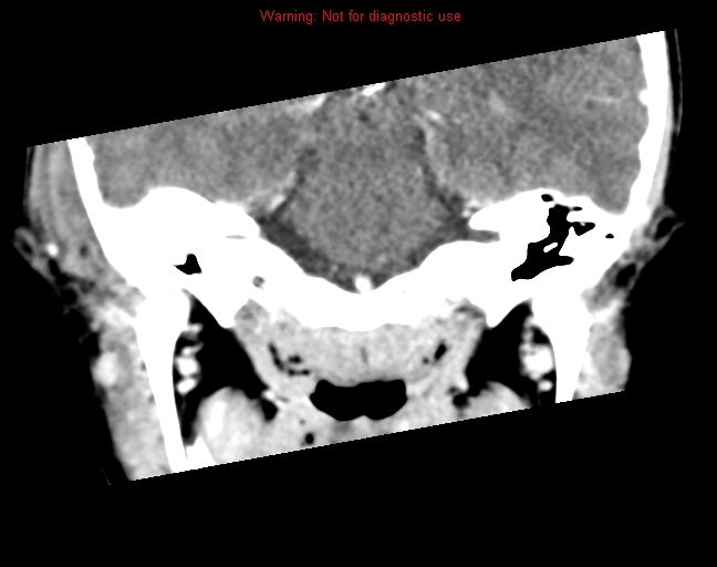File:Bezold abscess (Radiopaedia 21645-21605 C+ arterial phase 9).jpg