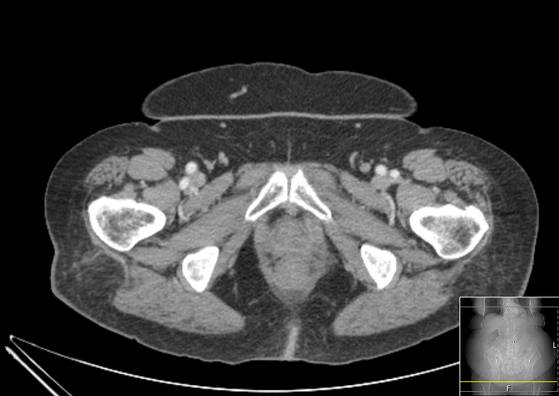 File:Bicameral celiacomesenteric aneurysm (Radiopaedia 55766-62327 A 76).jpg
