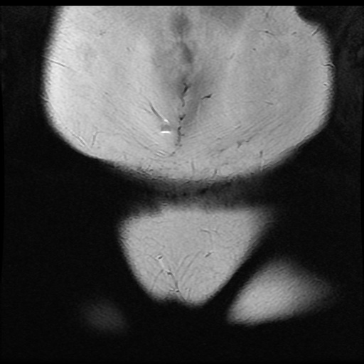 File:Bicornuate uterus (Radiopaedia 51676-57472 Coronal T2 2).jpg