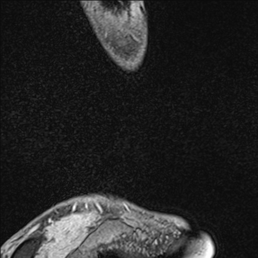 Bilateral Achilles tendon complete tear (Radiopaedia 81344-95051 Sagittal WE - Left 17).jpg