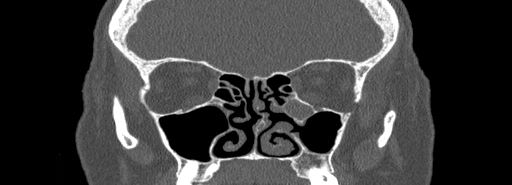 File:Bilateral Ectopic Infraorbital Nerves (Radiopaedia 49006-54084 Coronal bone window 37).jpg