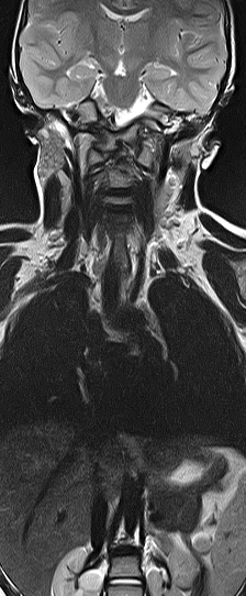File:Bilateral Sprengel deformity with Klippel-Feil syndrome (Radiopaedia 66395-75650 F 1).jpg