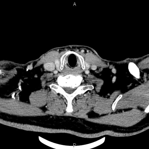 Bilateral Warthin tumors (Radiopaedia 84034-99263 Axial With contrast 51).jpg