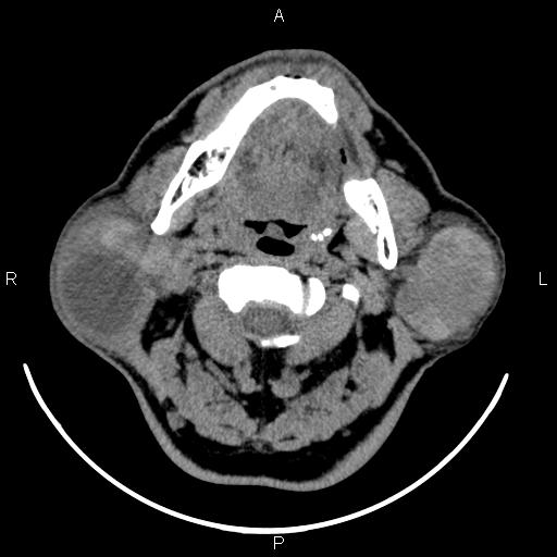 File:Bilateral Warthin tumors (Radiopaedia 84034-99263 Axial non-contrast 22).jpg