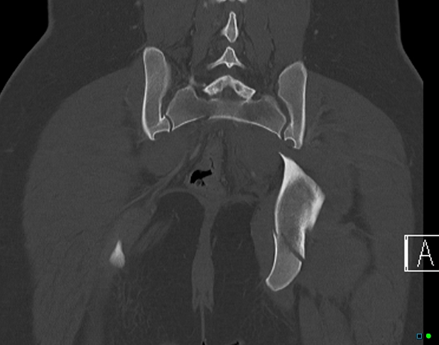 File:Bilateral acetabular fractures (Radiopaedia 79272-92308 Coronal bone window 33).jpg