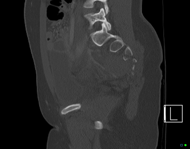 Bilateral acetabular fractures (Radiopaedia 79272-92308 Sagittal bone window 54).jpg