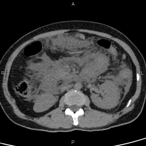 Bilateral adrenal gland hyperenhancement in pancreatitis (Radiopaedia 86642-102753 Axial non-contrast 51).jpg