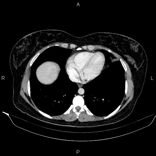 File:Bilateral adrenal myelolipoma (Radiopaedia 63058-71535 B 7).jpg