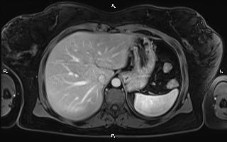 Bilateral adrenal myelolipoma (Radiopaedia 63058-71537 G 22).jpg