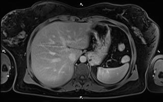 File:Bilateral adrenal myelolipoma (Radiopaedia 63058-71537 H 23).jpg