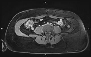 File:Bilateral adrenal myelolipoma (Radiopaedia 63058-71537 H 74).jpg