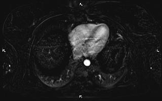Bilateral adrenal myelolipoma (Radiopaedia 63058-71537 I 10).jpg