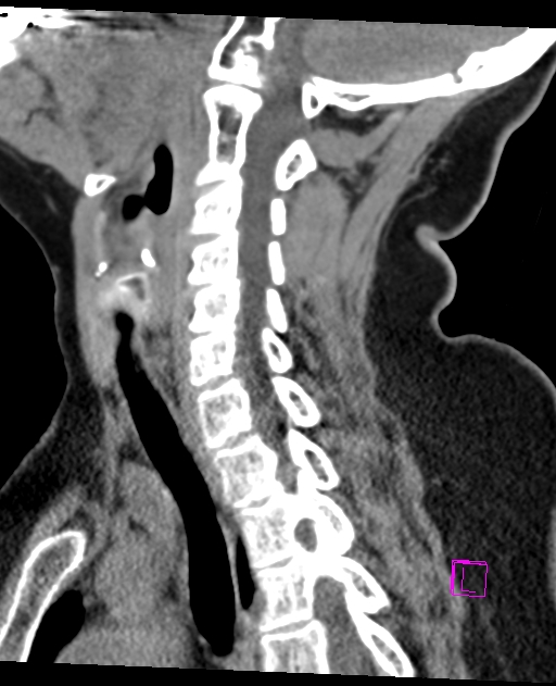 Bilateral atlanto-occipital assimilation (Radiopaedia 28350-28603 D 46).jpg