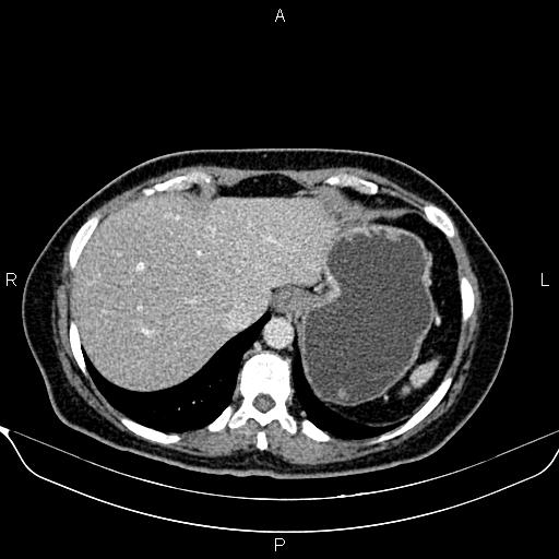 Bilateral benign adrenal adenomas (Radiopaedia 86912-103124 B 20).jpg