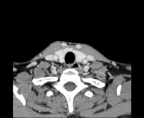 Bilateral carotid body tumors (Radiopaedia 61841-69870 Axial Post contrast 97).jpg