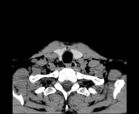 Bilateral carotid body tumors (Radiopaedia 61841-69870 Axial non-contrast 100).jpg