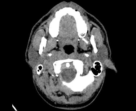 Bilateral carotid body tumors (Radiopaedia 61841-69870 Axial non-contrast 18).jpg
