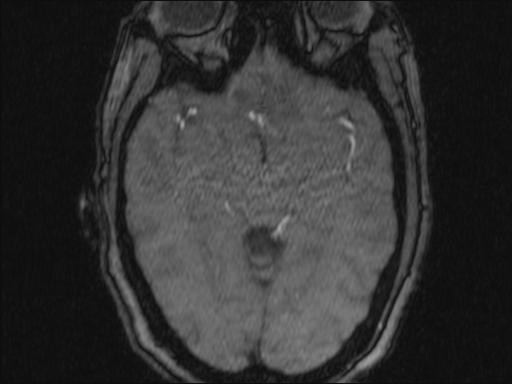 Bilateral carotid body tumors and right glomus jugulare tumor (Radiopaedia 20024-20060 Axial MRA 341).jpg