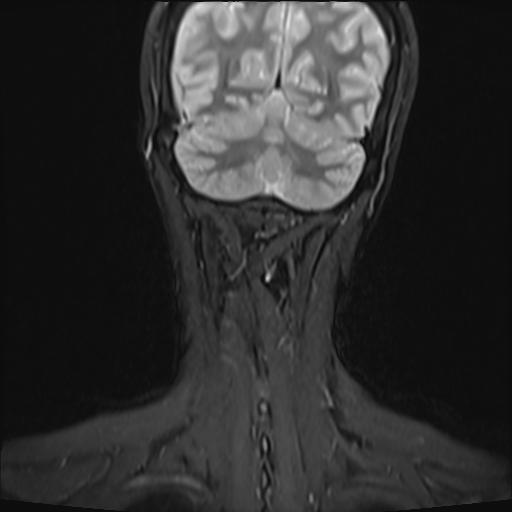 File:Bilateral carotid body tumors and right jugular paraganglioma (Radiopaedia 20024-20060 Coronal 45).jpg
