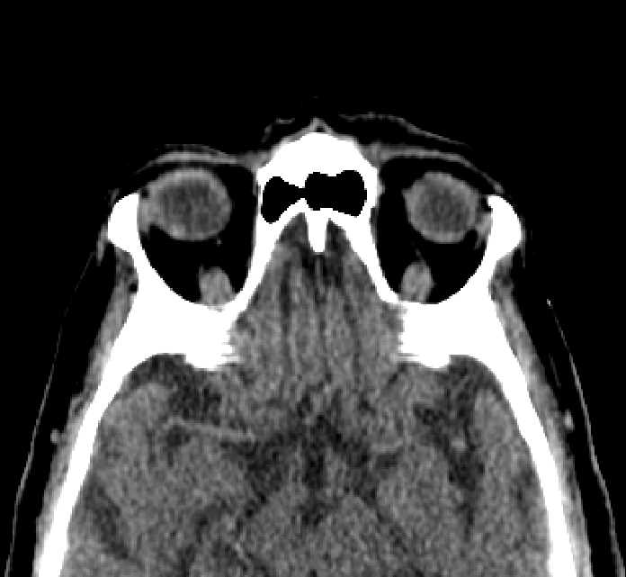 Bilateral ectopia lentis (Radiopaedia 89889-107013 Axial non-contrast 21).jpg
