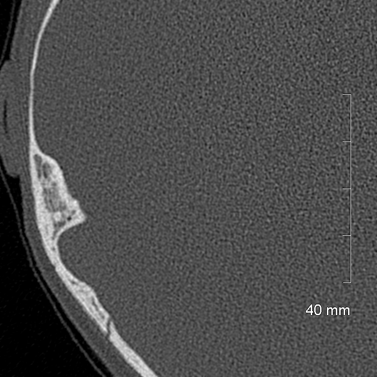 Bilateral grommets (Radiopaedia 47710-52404 Axial bone window 68).jpg