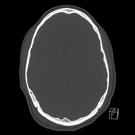 File:Bilateral occipital condyle fracture (type 2) (Radiopaedia 87675-104089 Axial bone window 71).jpg