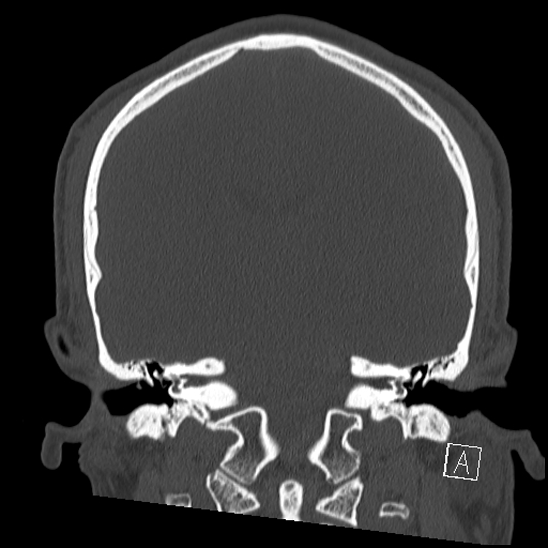Bilateral occipital condyle fracture (type 2) (Radiopaedia 87675-104089 Coronal bone window 77).jpg