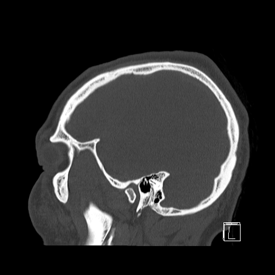 Bilateral occipital condyle fracture (type 2) (Radiopaedia 87675-104089 Sagittal bone window 95).jpg