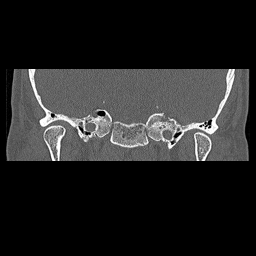 File:Bilateral ossifications of the external auditory canal (Radiopaedia 15233-15076 Coronal bone window 2).jpg