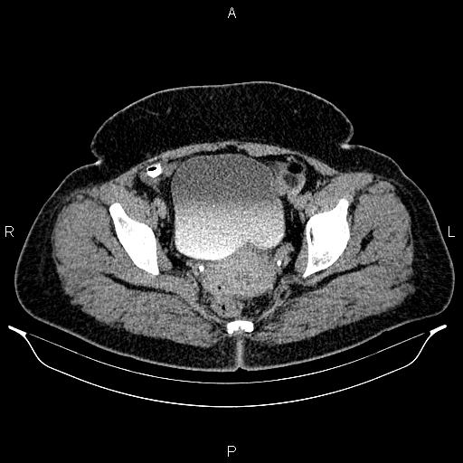 Bilateral ovarian dermoid cysts (Radiopaedia 85785-101603 Axial C+ delayed 76).jpg