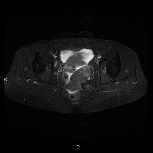 File:Bilateral ovarian fibroma (Radiopaedia 44568-48293 Axial STIR 18).jpg