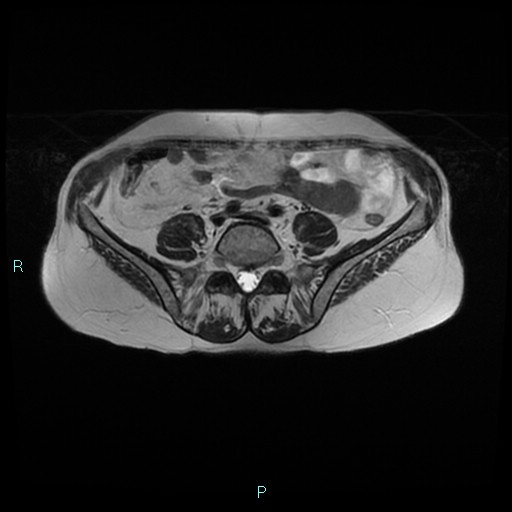 File:Bilateral ovarian fibroma (Radiopaedia 44568-48293 Axial T2 1).jpg