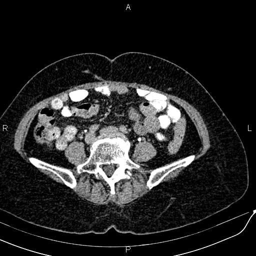 Bilateral ovarian serous cystadenocarcinoma (Radiopaedia 86062-101989 Axial C+ delayed 48).jpg