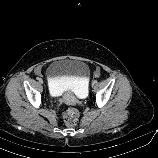 File:Bilateral ovarian serous cystadenocarcinoma (Radiopaedia 86062-101989 Axial C+ delayed 69).jpg