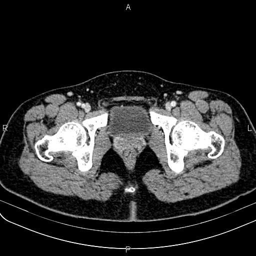 Bilateral ovarian teratoma (Radiopaedia 83131-97503 Axial With contrast 74).jpg