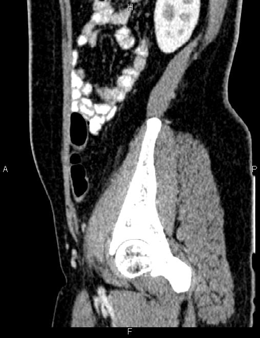 Bilateral ovarian teratoma (Radiopaedia 83131-97503 D 86).jpg