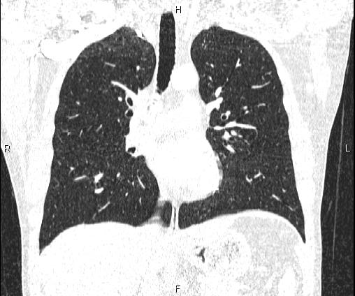 Bilateral pulmonary AVM (Radiopaedia 83134-97505 Coronal lung window 43).jpg