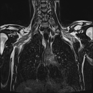 Bilateral spinoglenoid notch ganglion cysts (Radiopaedia 29577-30082 Coronal T2 51).jpg
