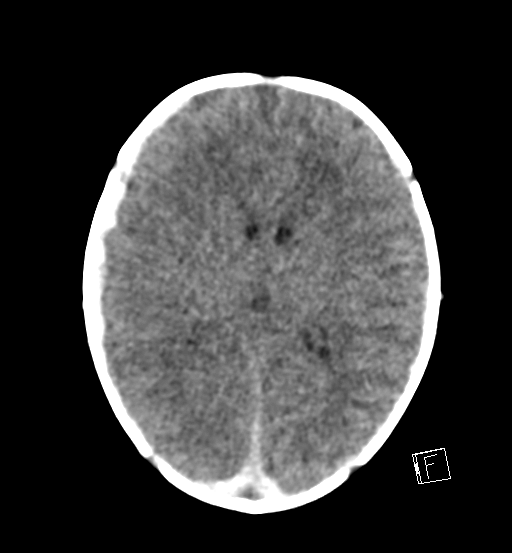 File:Bilateral subdural hemorrhage and parietal skull fracture (Radiopaedia 26058-26192 Axial non-contrast 11).png
