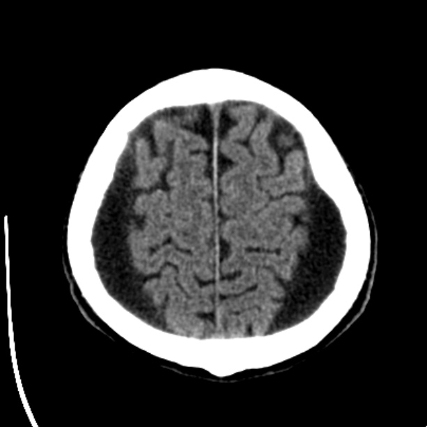Bilateral subdural hygromata (Radiopaedia 29245-29656 Axial non-contrast 40).jpg