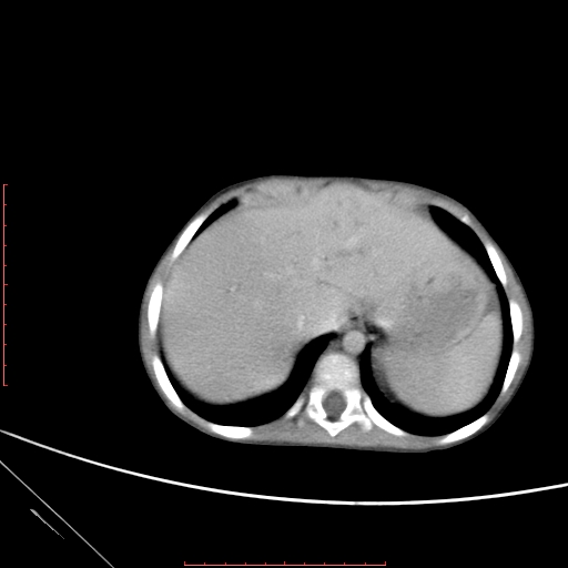 Biliary tract embryonal rhabdomyosarcoma (Radiopaedia 51815-57648 A 3).jpg