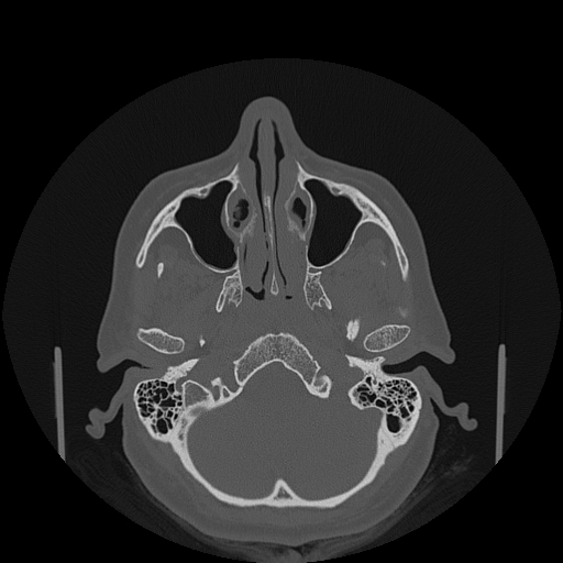 File:Bisphosphonate-related osteonecrosis of the jaw (Radiopaedia 71324-81642 Axial bone window 145).jpg